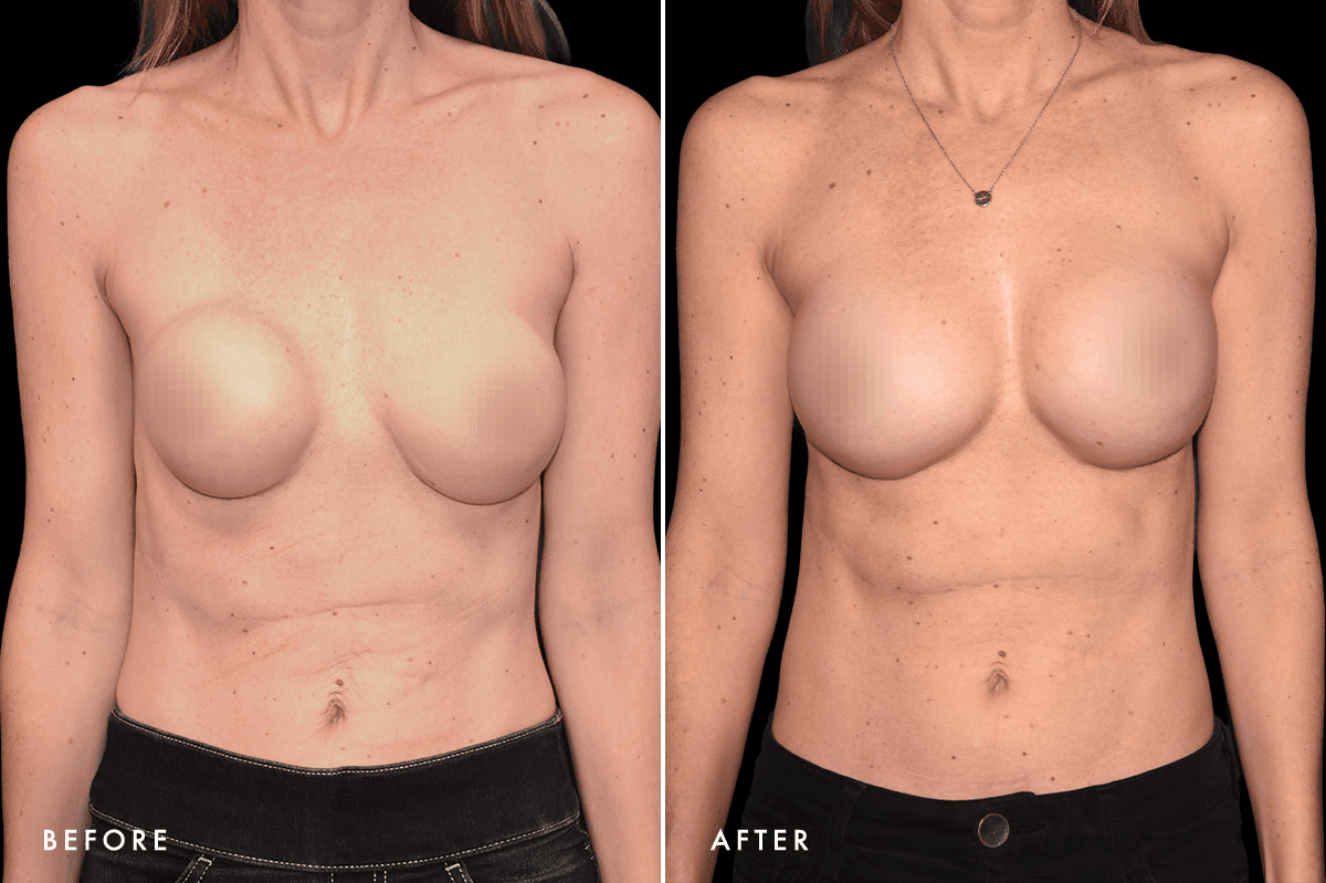 DM Capsular Contracture Correction B&A — Patient 2 Front