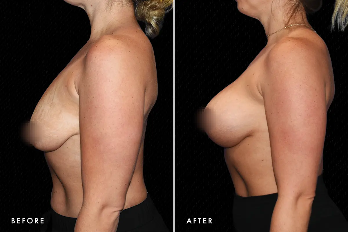 pinnacleskin.com /treatments/breast-lift Carousel 3 Image 3