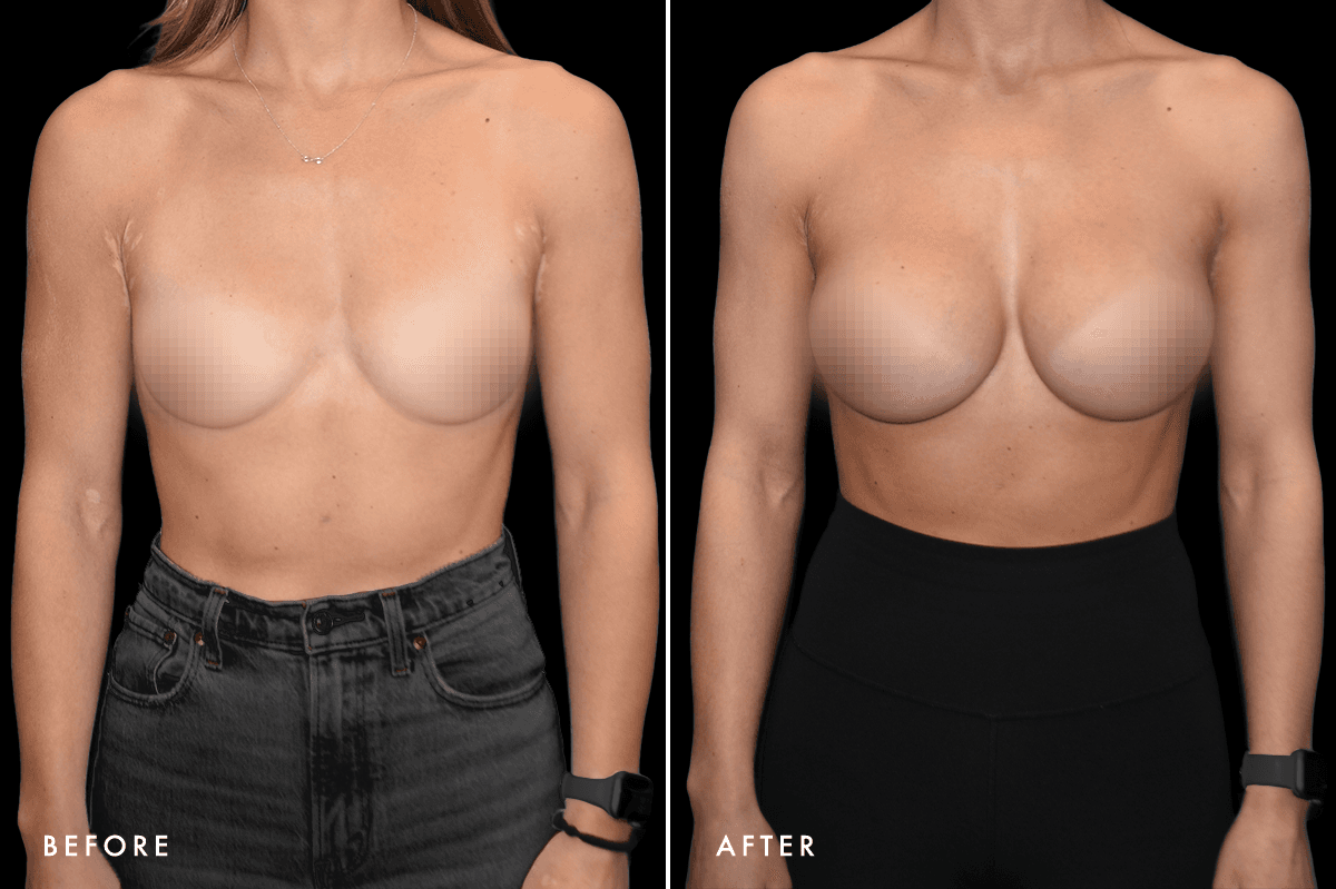 DM Breast Augmentation Gallery — Patient 4 Front