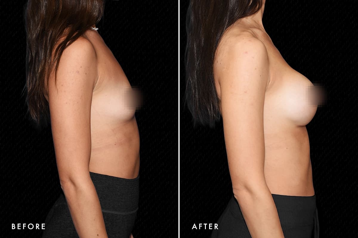 pinnacleskin.com /treatments/breast-augmentation Carousel 3 Image 6