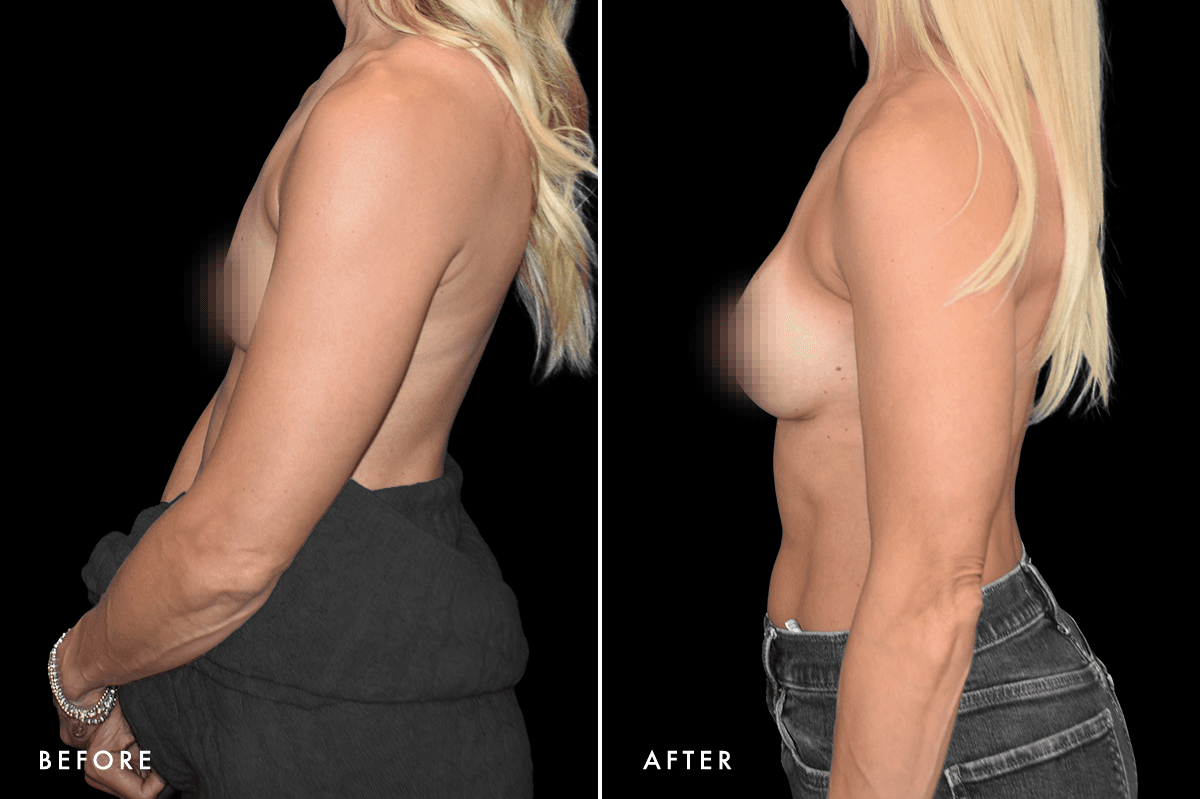 DM Ballerina Breast Augmentation B&A — Patient 1 Side