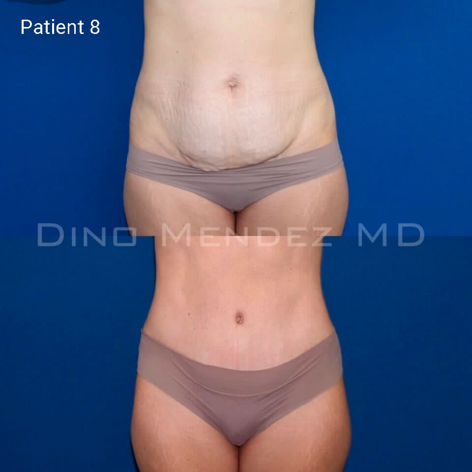pinnacleskin.com /treatments/tummy-tuck Carousel 3 Image 5