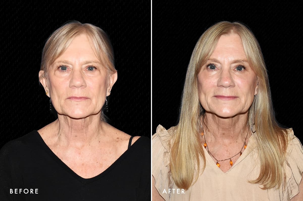 DM Lower Bleph Patient 1 Front Before After