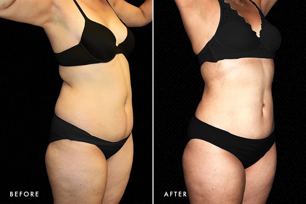 pinnacleskin.com /treatments/liposuction Carousel 1 Image 2
