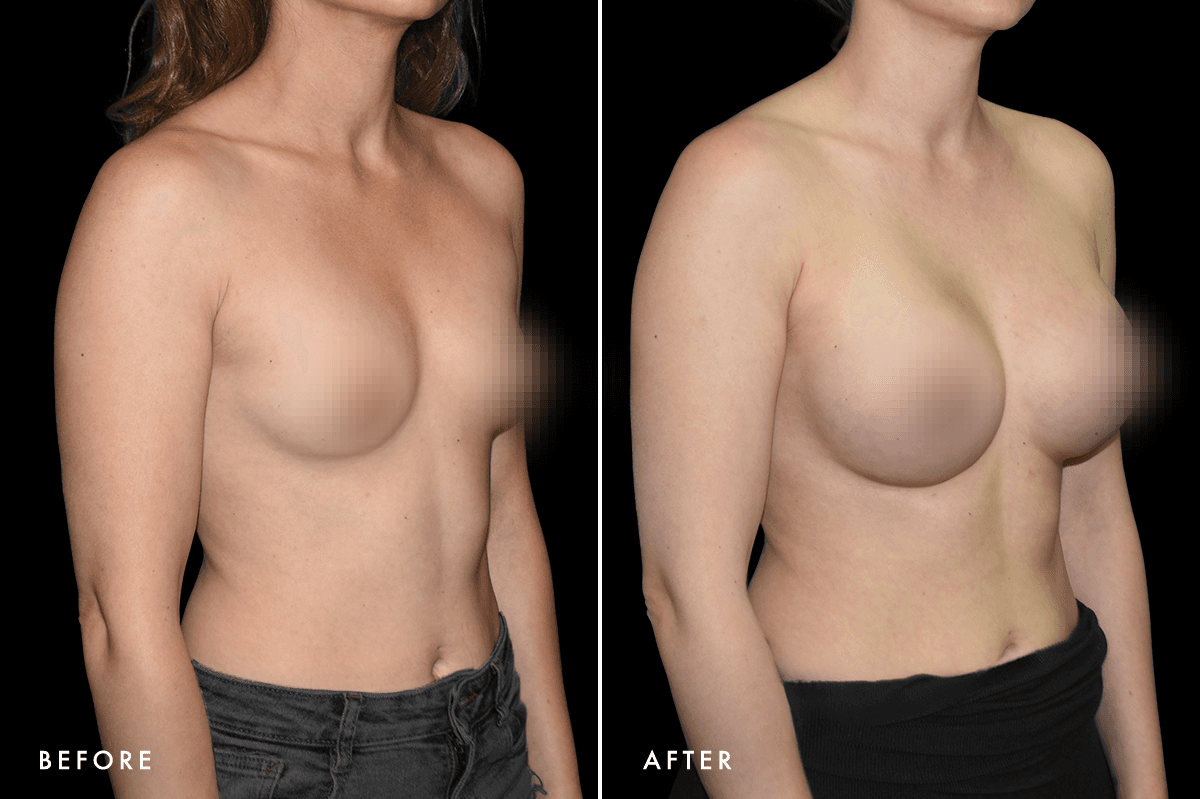 DM Breast Augmentation Gallery — Patient 5 Angle