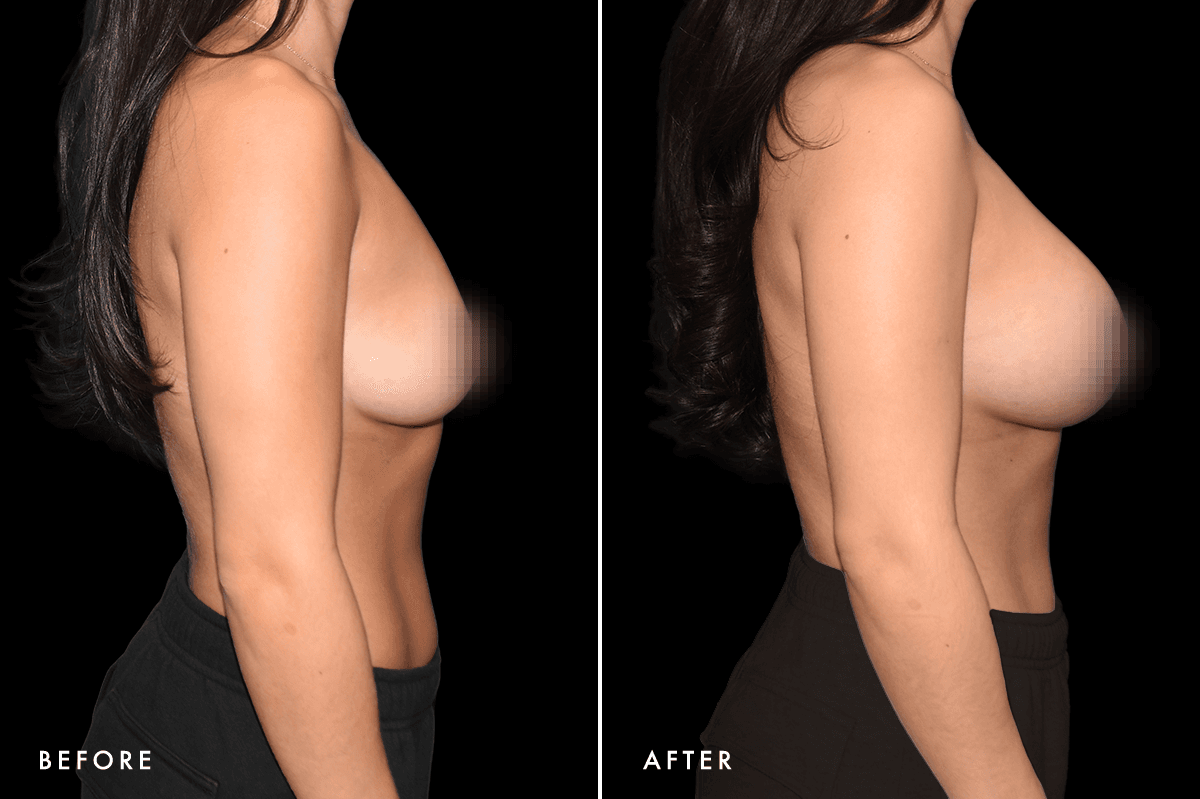 DM Breast Augmentation Gallery — Patient 8 Side
