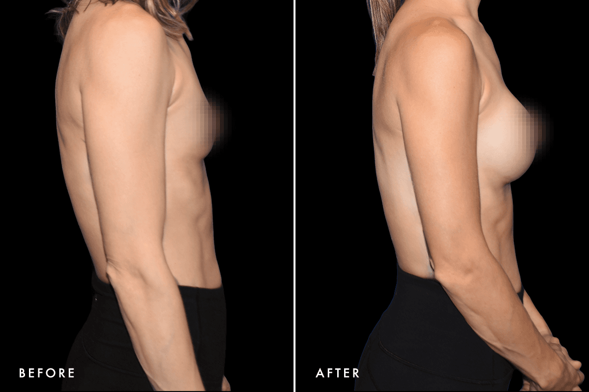 DM Ballerina Breast Augmentation B&A — Patient 3 Side
