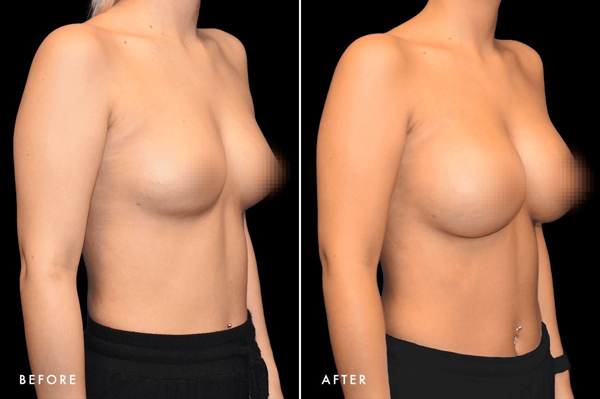 DM Breast Augmentation Gallery — Patient 1 Angle