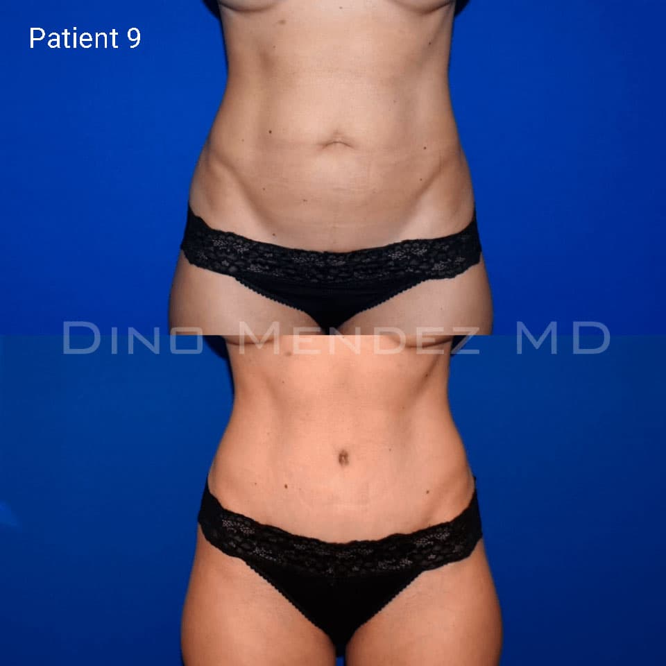 pinnacleskin.com /treatments/tummy-tuck Carousel 3 Image 7