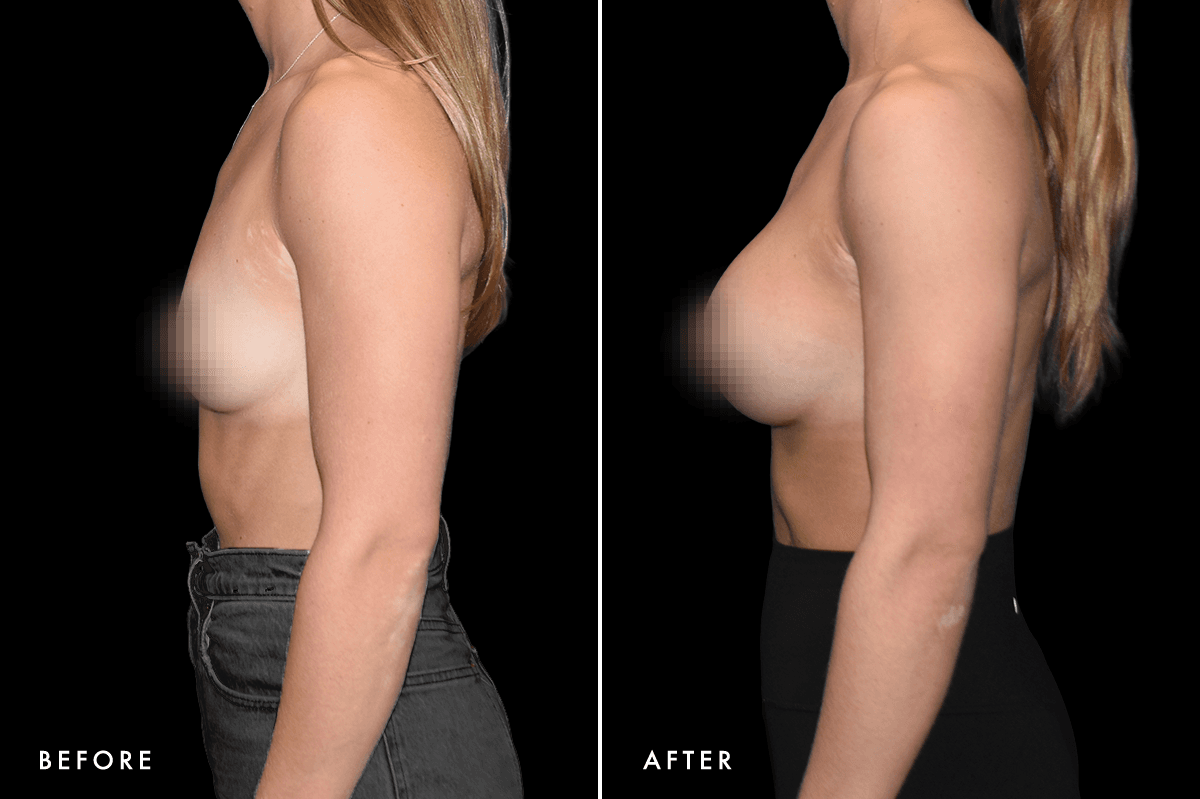 DM Breast Augmentation Gallery — Patient 4 Side