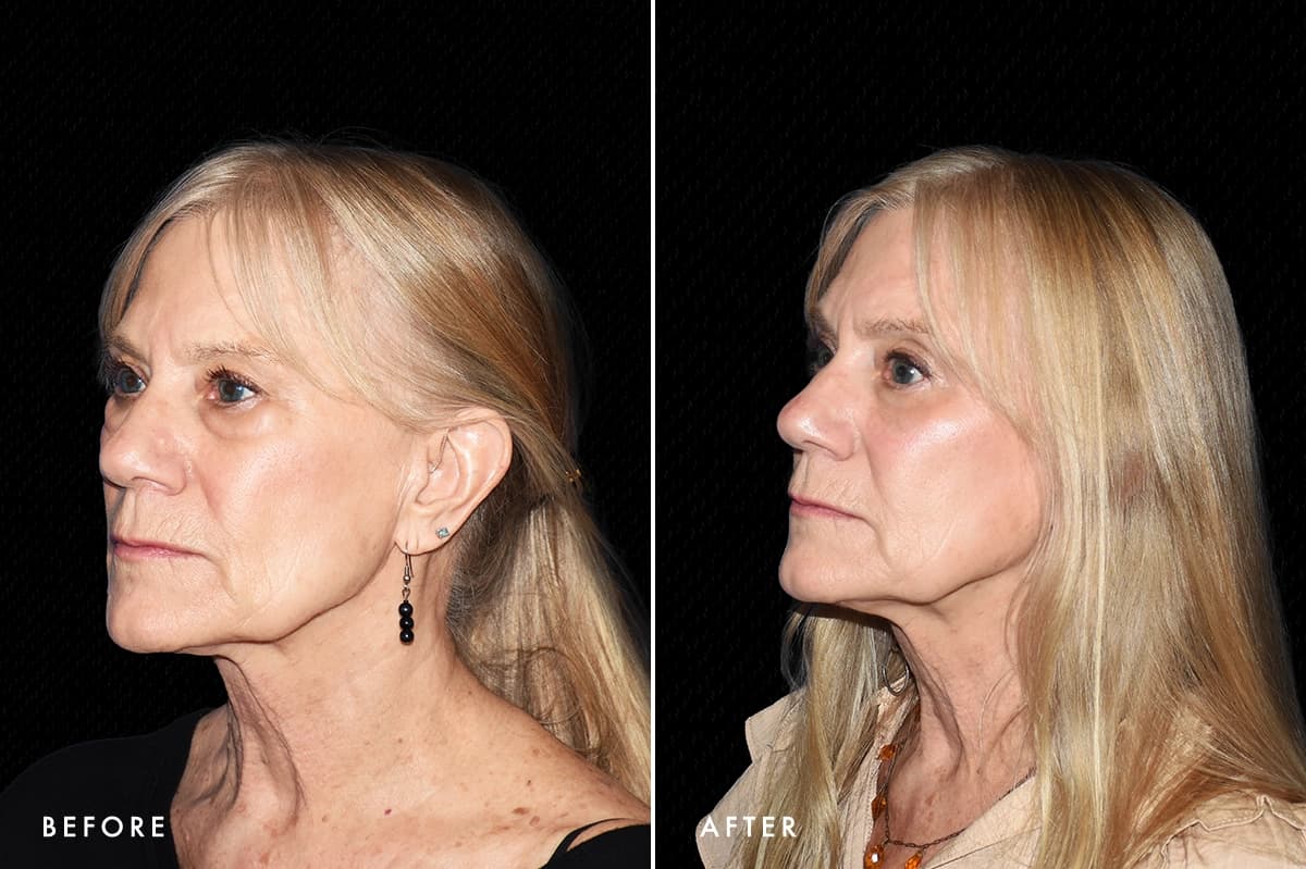 DM Lower Bleph Patient 1 Angle Before After
