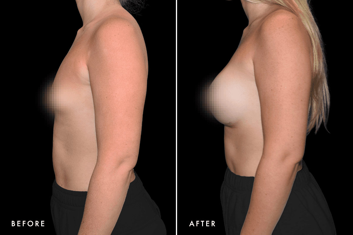 DM Tuberous Breast Correction B&A — Patient 1 Side
