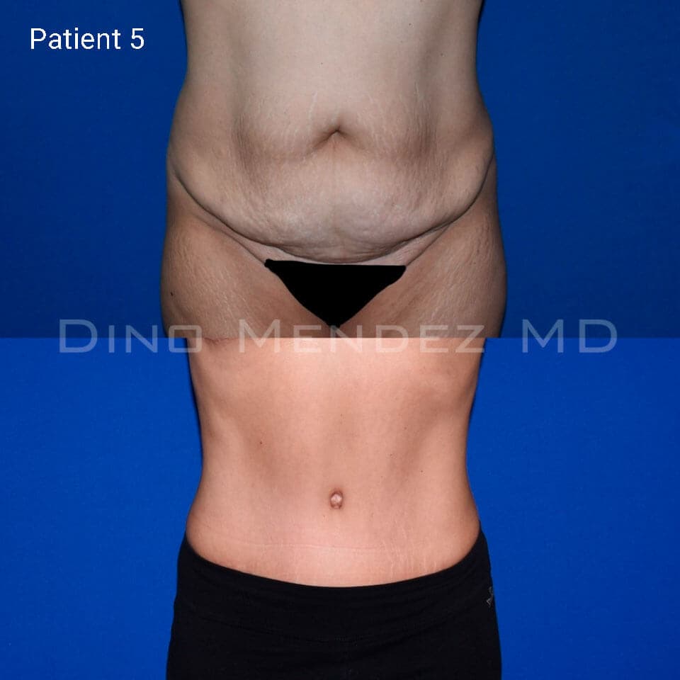 pinnacleskin.com /treatments/tummy-tuck Carousel 2 Image 8