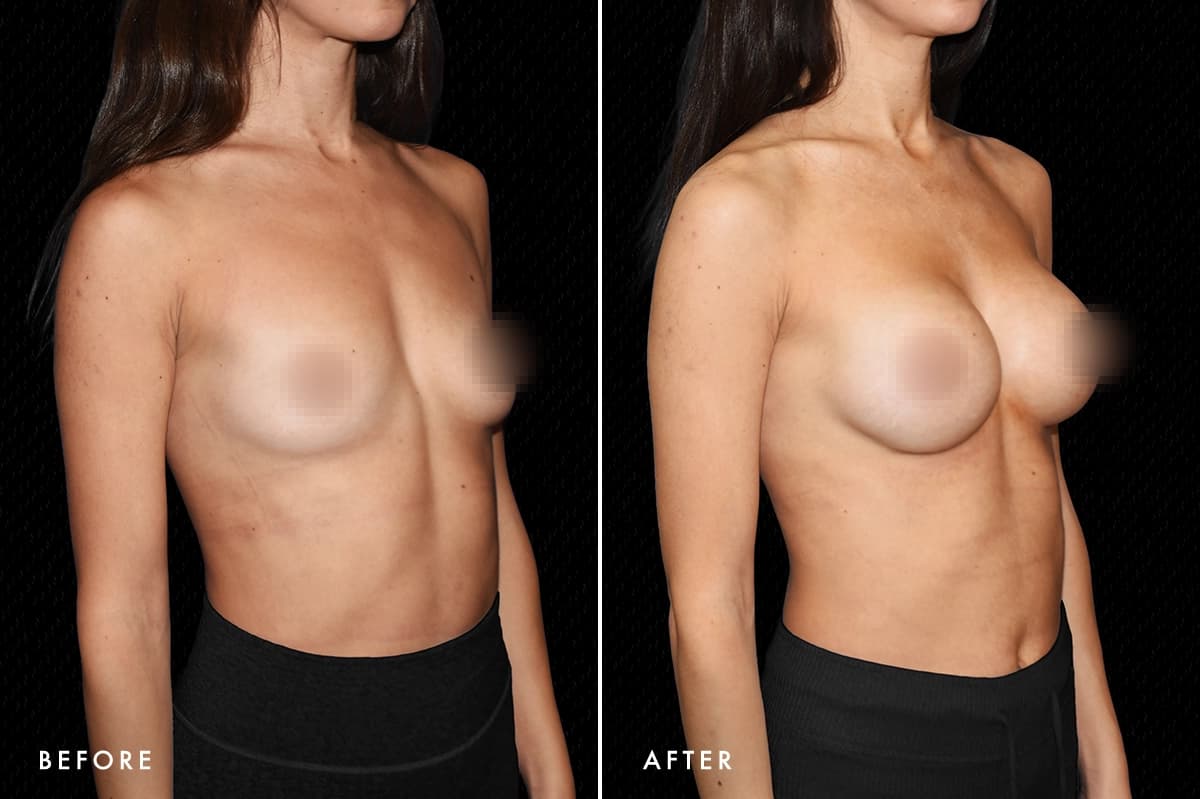 pinnacleskin.com /treatments/breast-augmentation Carousel 3 Image 5