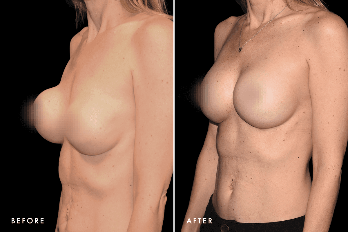 DM Capsular Contracture Correction B&A — Patient 2 Angle