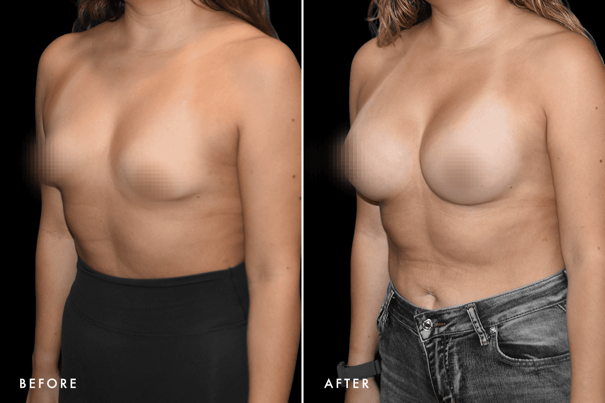 DM Tuberous Breast Correction B&A — Patient 2 Angle