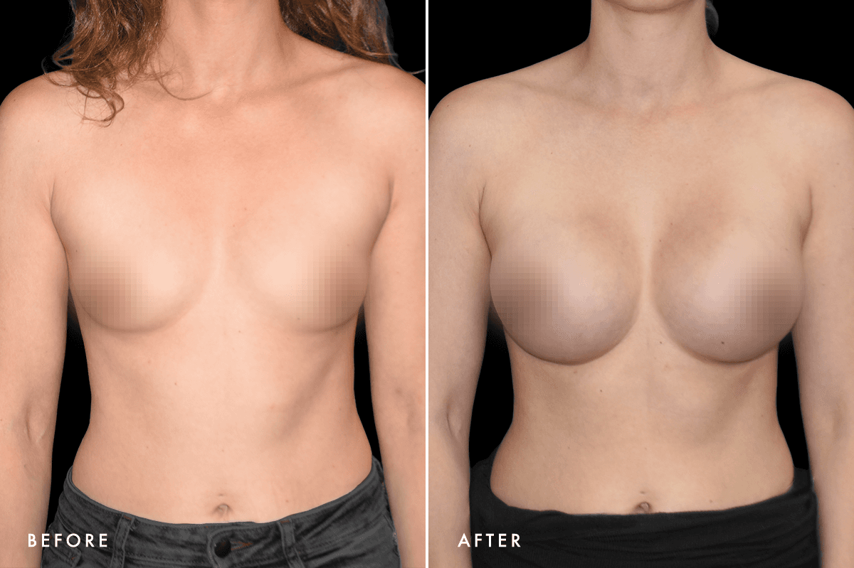DM Breast Augmentation Gallery — Patient 5 Front