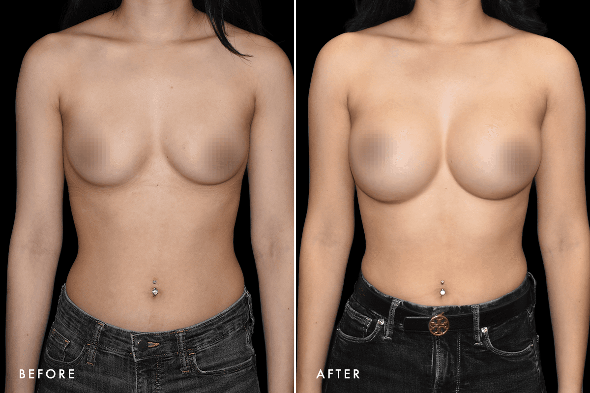 DM Breast Augmentation Gallery — Patient 2 Front