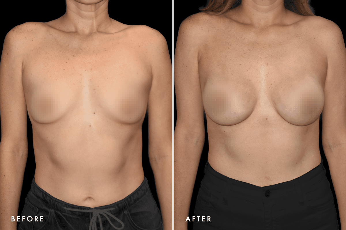 DM Breast Augmentation Gallery — Patient 6 Front