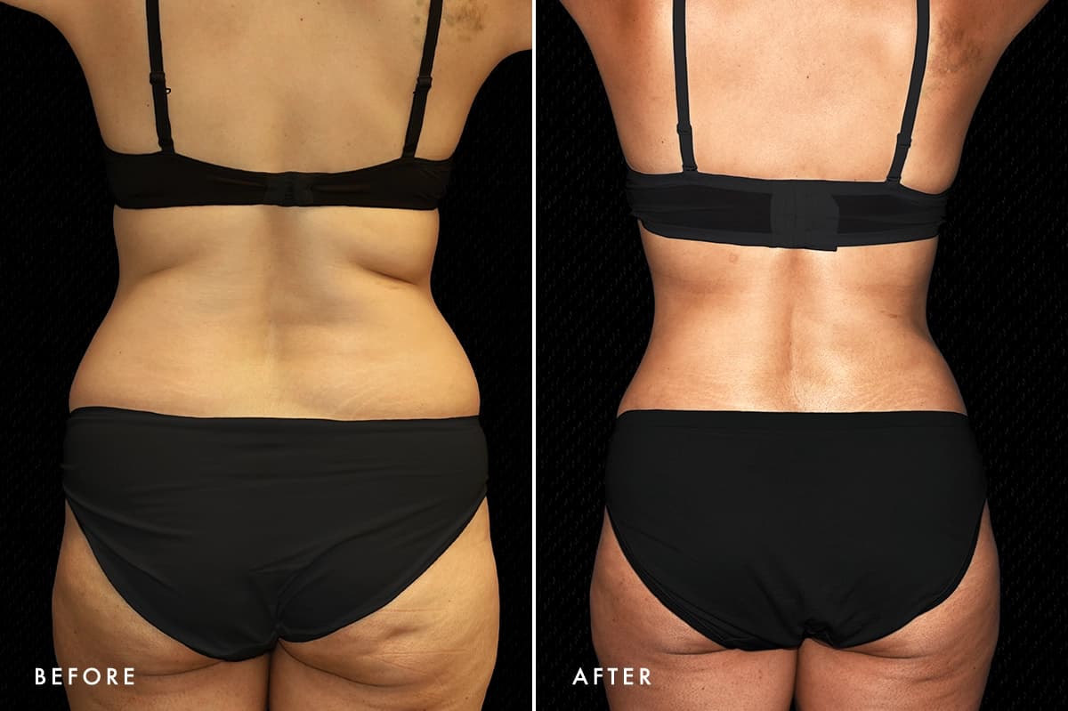 pinnacleskin.com /treatments/liposuction Carousel 2 Image 1