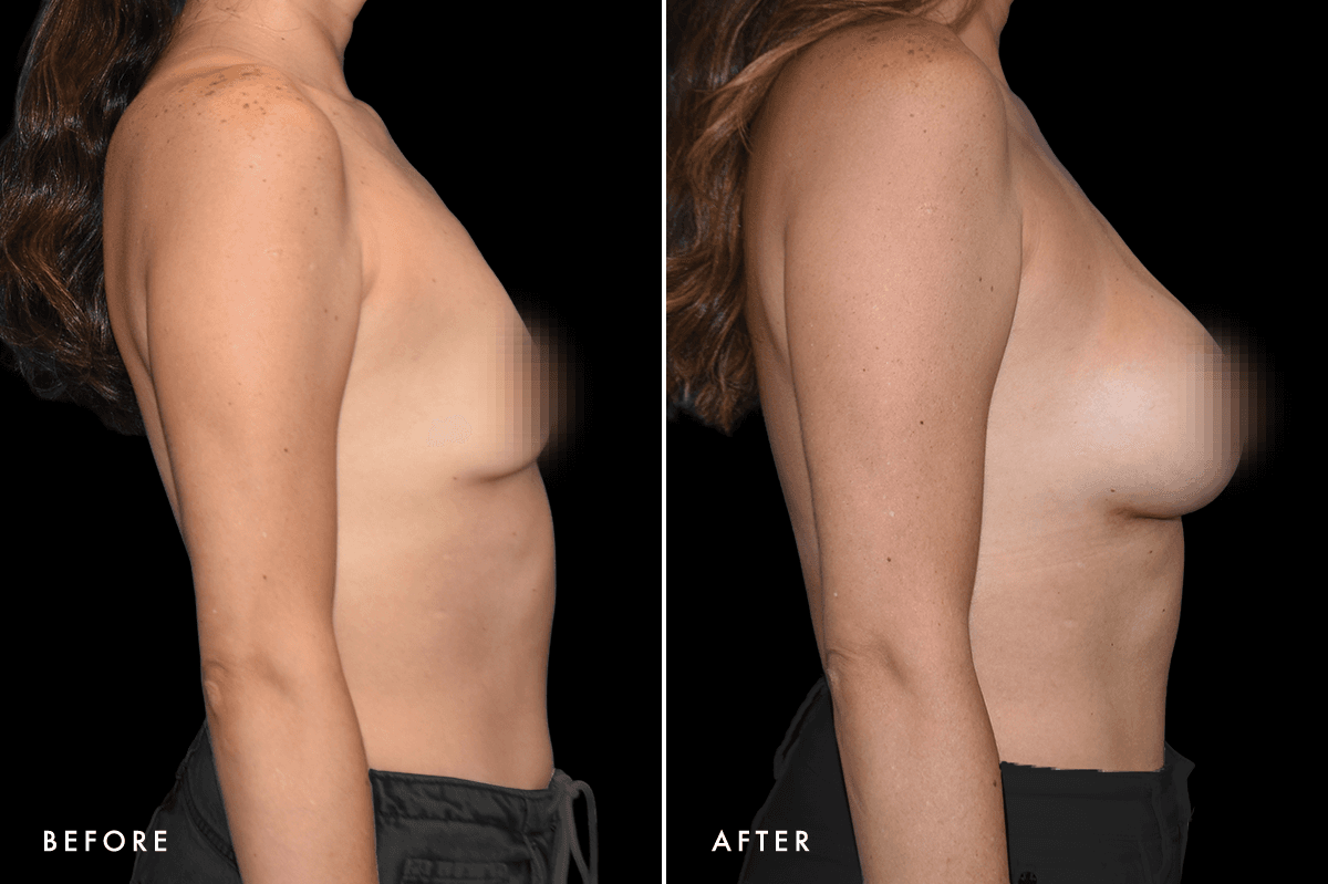 DM Breast Augmentation Gallery — Patient 6 Side