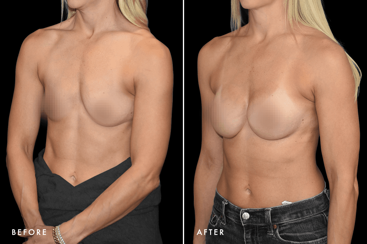 DM Ballerina Breast Augmentation B&A — Patient 1 Angle