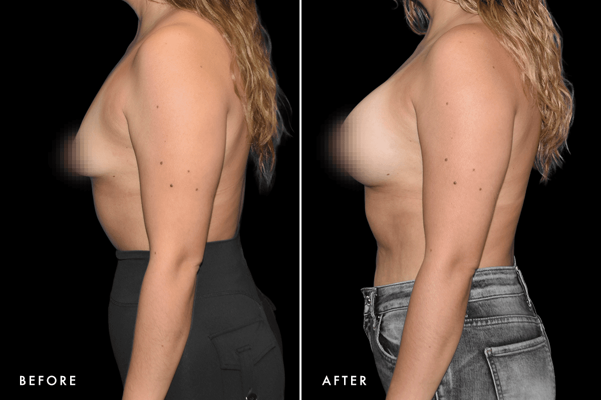 DM Tuberous Breast Correction B&A — Patient 2 Side