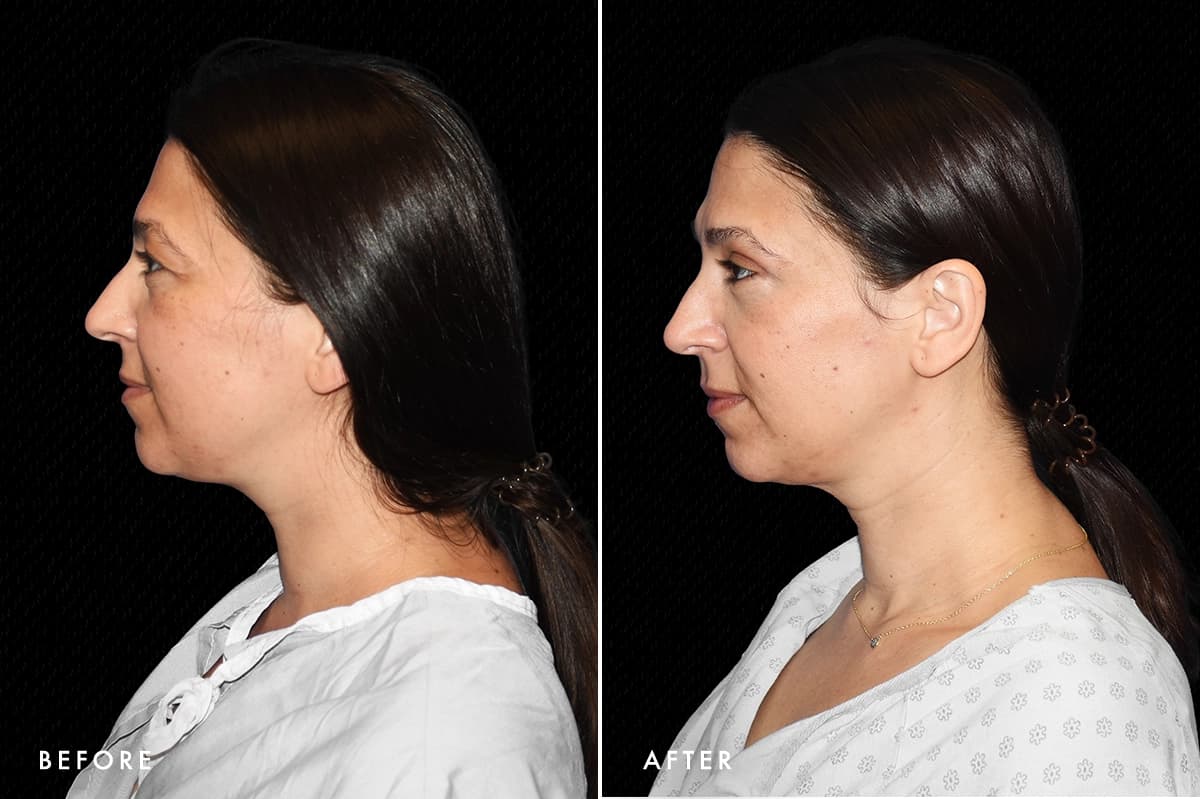 DM Upper Bleph Patient 1 Profile Before After