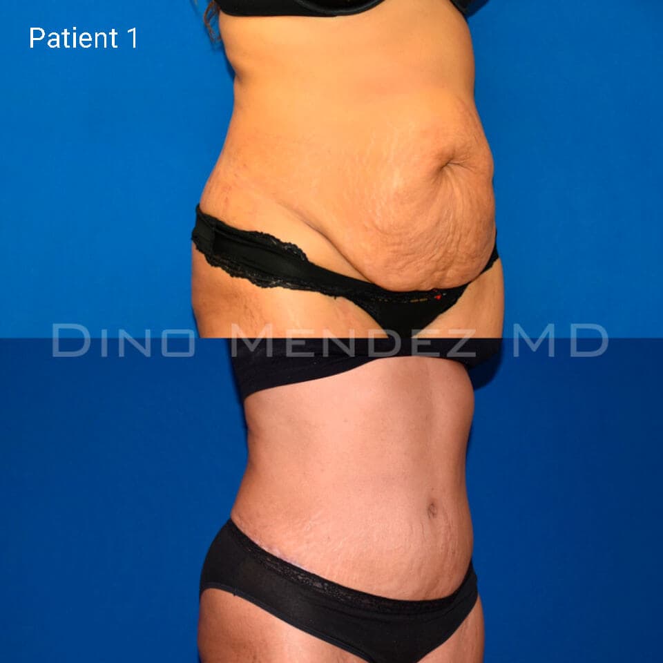 pinnacleskin.com /treatments/tummy-tuck Carousel 2 Image 2