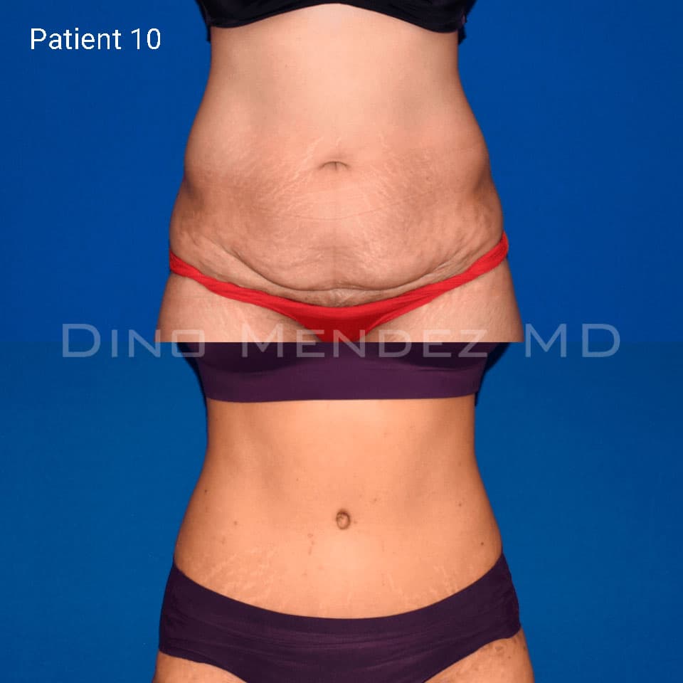 pinnacleskin.com /treatments/tummy-tuck Carousel 3 Image 9