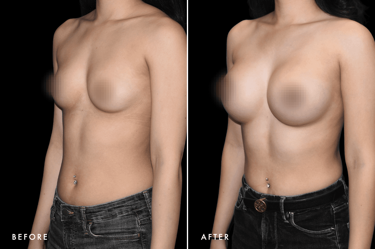 DM Breast Augmentation Gallery — Patient 2 Angle