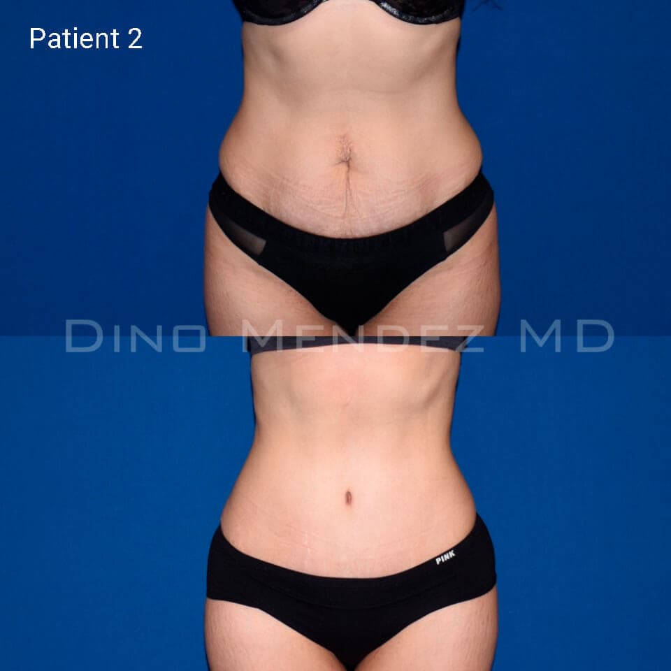 pinnacleskin.com /treatments/tummy-tuck Carousel 2 Image 3