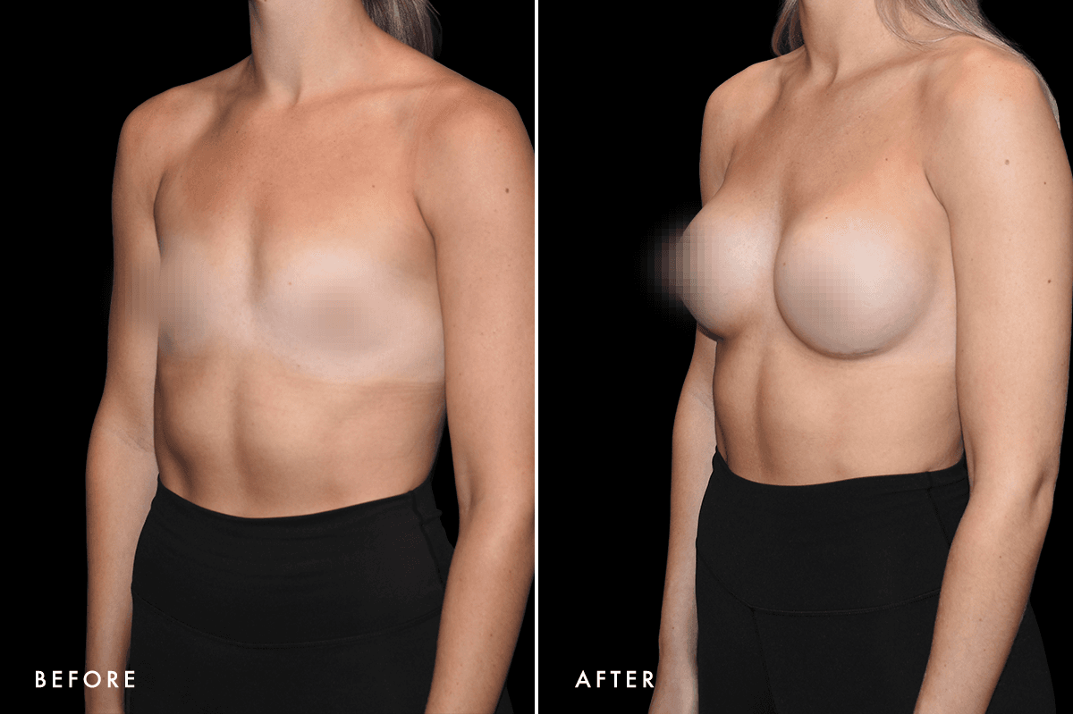 DM Breast Augmentation Gallery — Patient 10 Angle