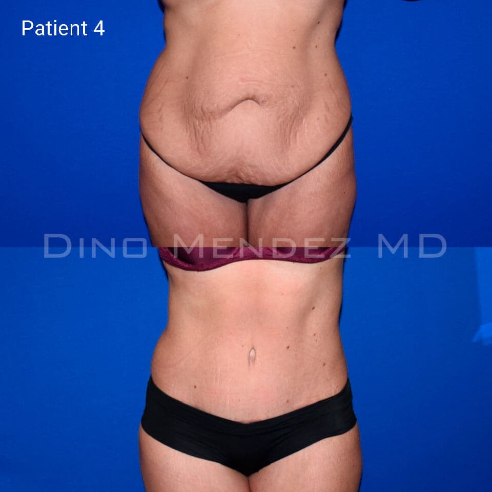 pinnacleskin.com /treatments/tummy-tuck Carousel 2 Image 7