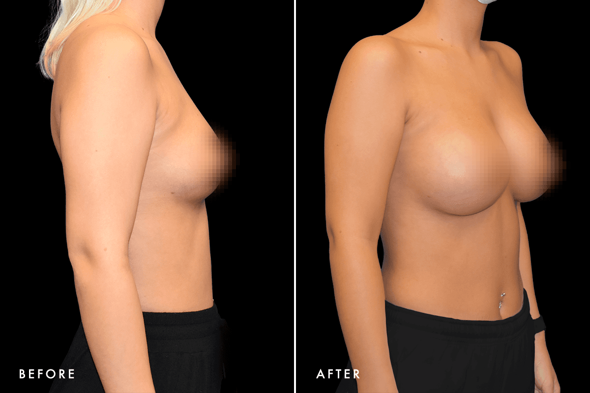 DM Breast Augmentation Gallery — Patient 1 Side
