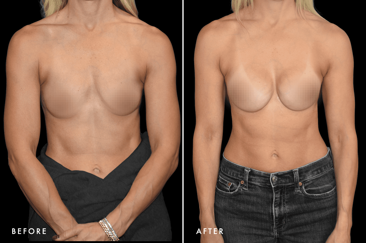 DM Ballerina Breast Augmentation B&A — Patient 1 Front