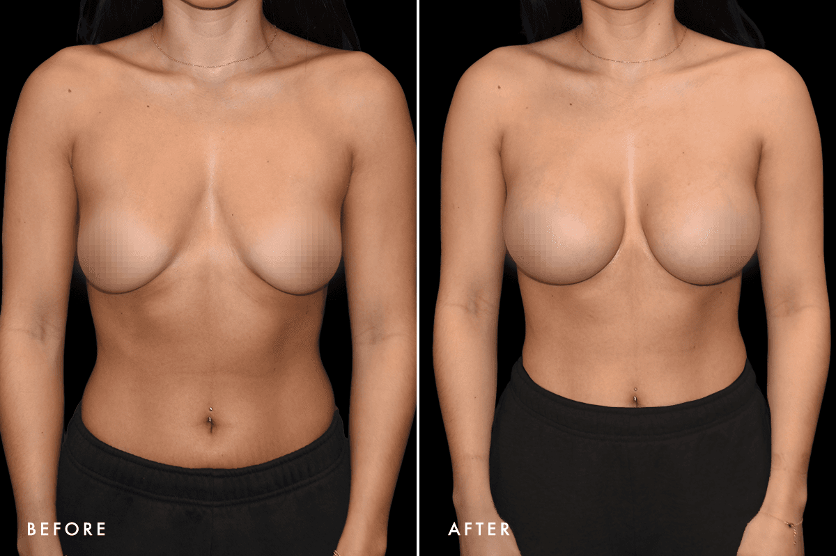 DM Breast Augmentation Gallery — Patient 8 Front