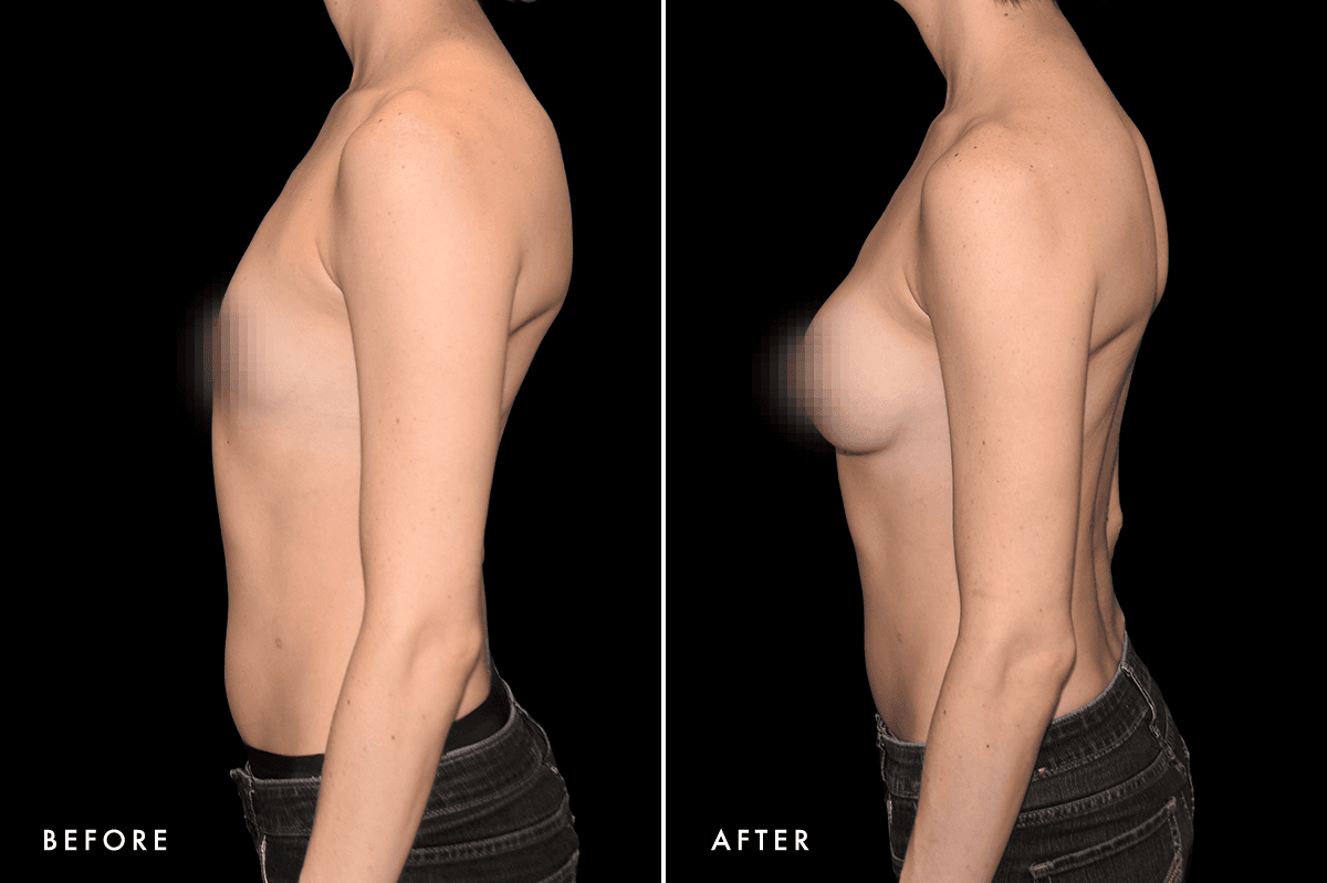 DM Ballerina Breast Augmentation B&A — Patient 2 Angle