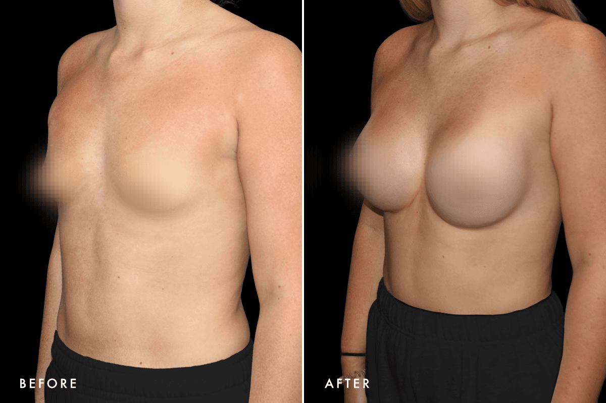 DM Tuberous Breast Correction B&A — Patient 1 Angle
