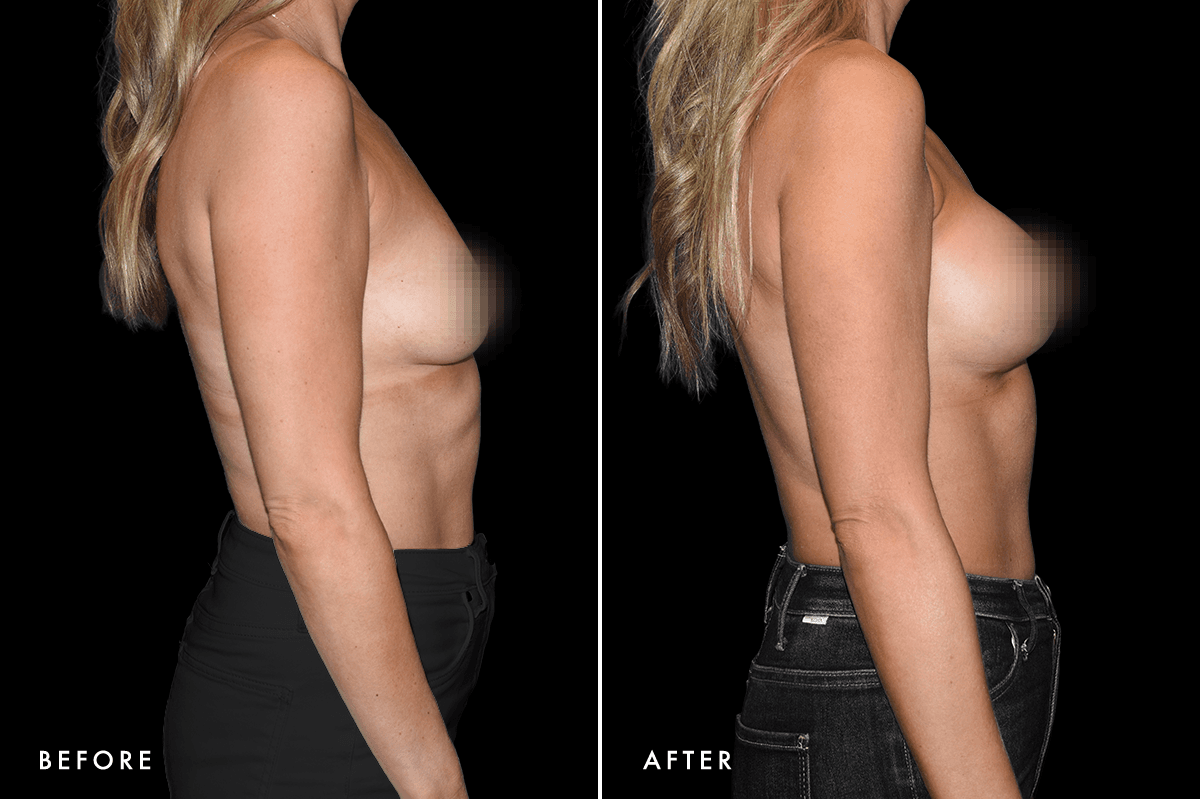 DM Breast Augmentation Gallery — Patient 9 Side