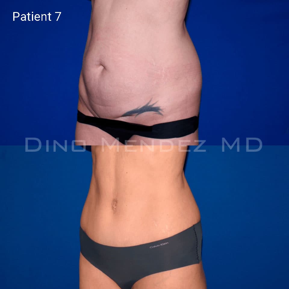 pinnacleskin.com /treatments/tummy-tuck Carousel 3 Image 4
