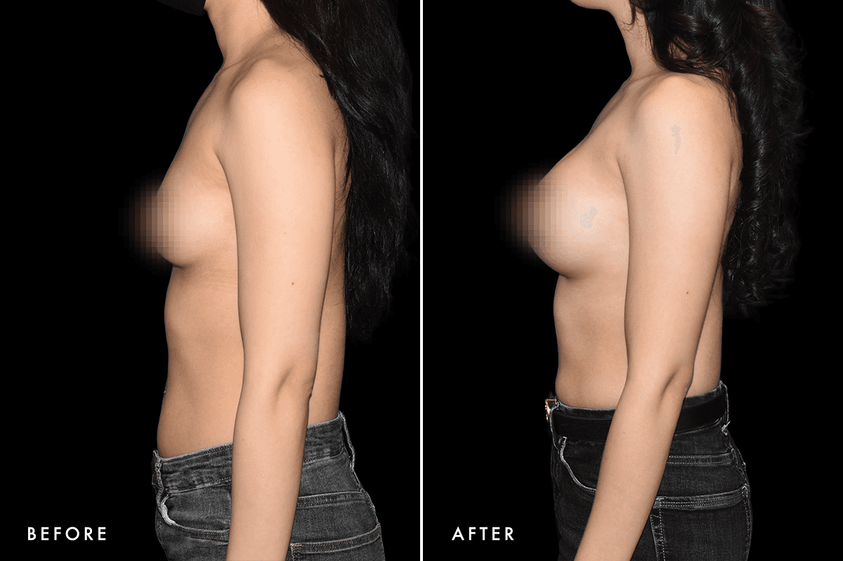 DM Breast Augmentation Gallery — Patient 2 Side