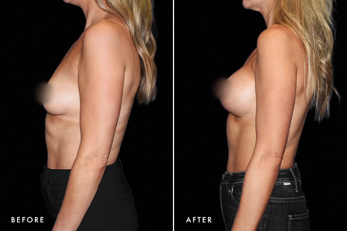pinnacleskin.com /treatments/breast-augmentation Carousel 3 Image 3