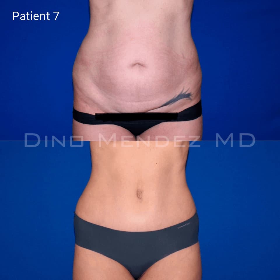 pinnacleskin.com /treatments/tummy-tuck Carousel 3 Image 3
