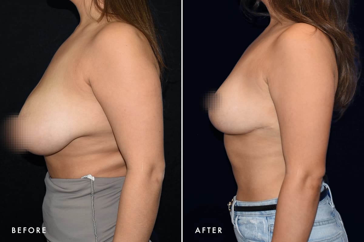 pinnacleskin.com /treatments/breast-lift Carousel 3 Image 6