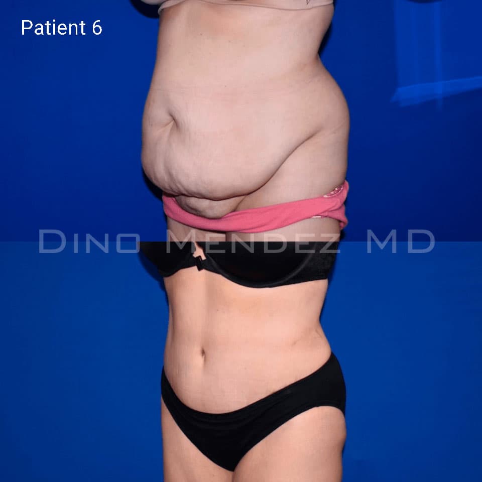 pinnacleskin.com /treatments/tummy-tuck Carousel 3 Image 2