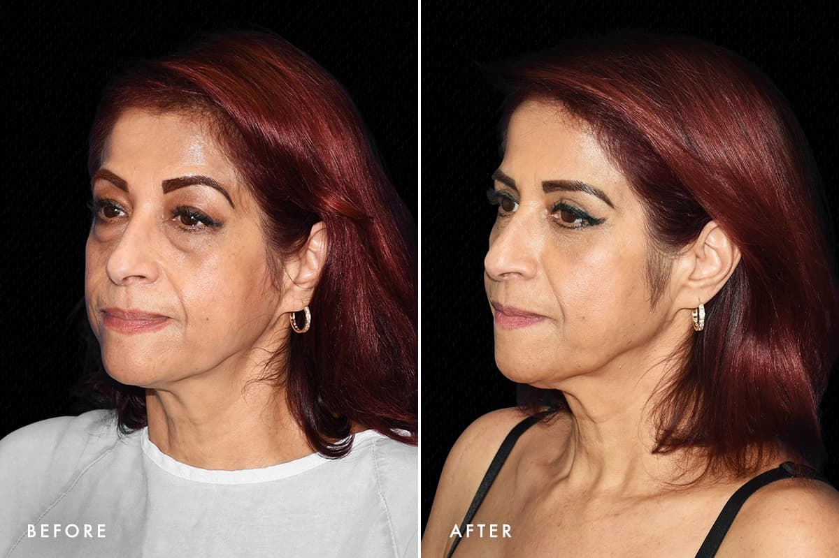 DM Lower Bleph Patient 2 Angle Before After