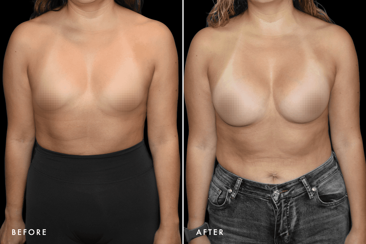 DM Tuberous Breast Correction B&A — Patient 2 Front