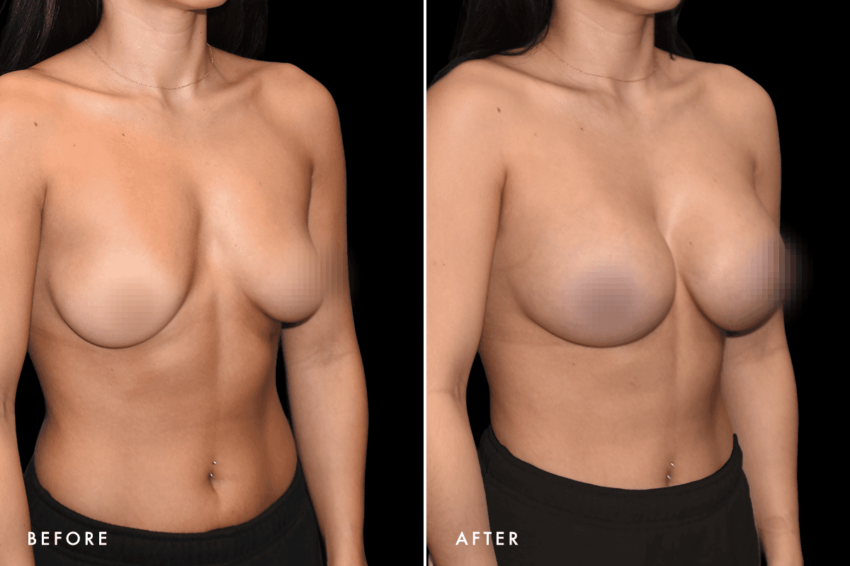 DM Breast Augmentation Gallery — Patient 8 Angle