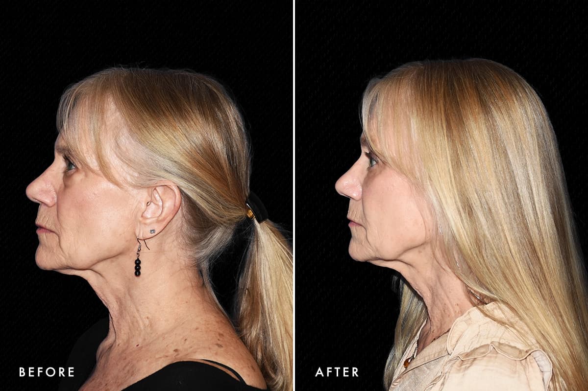 DM Lower Bleph Patient 1 Profile Before After